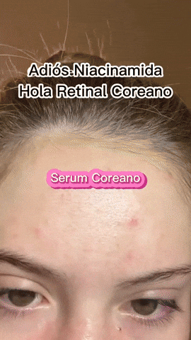 Retinal Coreano Milagroso - te quita el acné y cambia tu apariencia