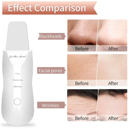 Limpiador Facial Ultrasónico